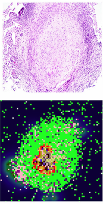 Figure 2. Tuberculosis granulomas from a non-human primate (top) and computer modeled (bottom). These are about 2mm big, about the width of a nickel. The granuloma wall is mostly composed of inactive macrophages (bright green, bottom). Since Mtb doesn’t stain readily, the bacteria (olive green, bottom) aren’t readily visible in the stained granuloma (top). Other cell types present include: activated macrophages (blue), infected macrophages (orange, red), and T cells (pink, purple, light blue). [Source](http://www.dx.doi.org/10.1371/journal.pcbi.1004804), Fig. 3c)